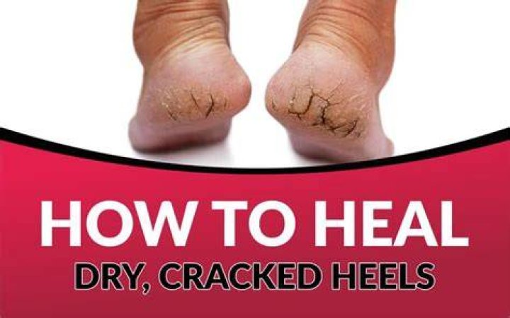 What do you soak cracked heels in?