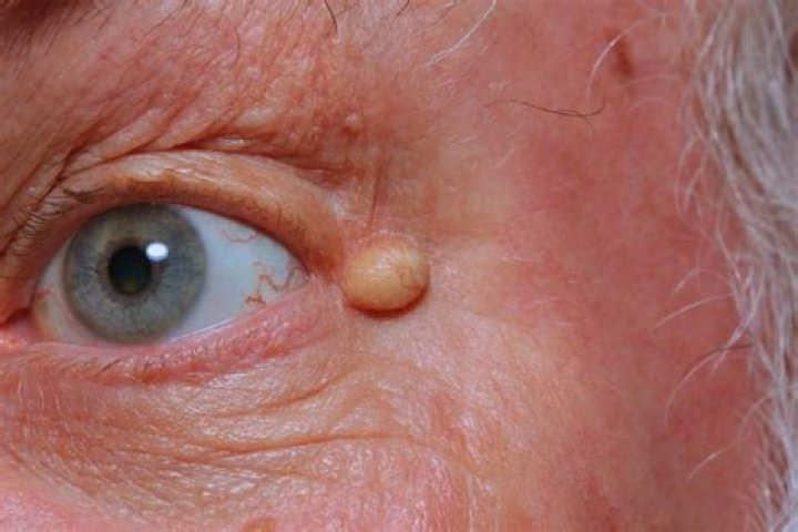 What does a epidermoid cyst look like?