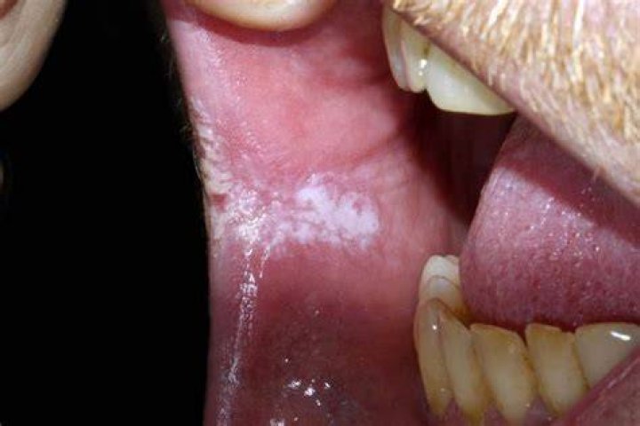 What does leukoplakia look like?
