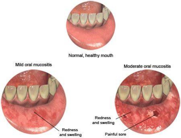 What does oral mucositis look like?