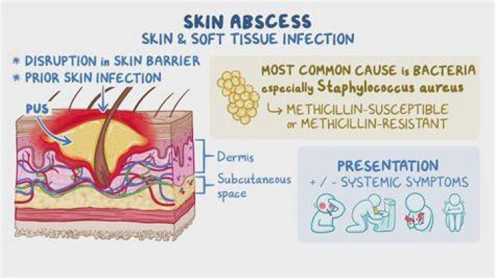 What happens if a abscess bursts?