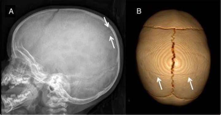 What is a hairline skull fracture?