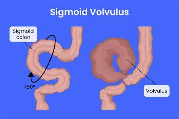 What is a twisted bowel in adults?