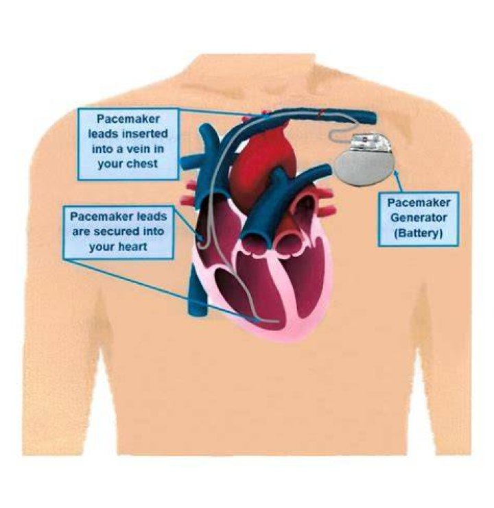 What is an alternative to a pacemaker?