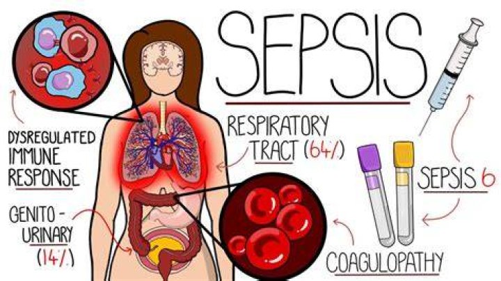 What is bowel sepsis?