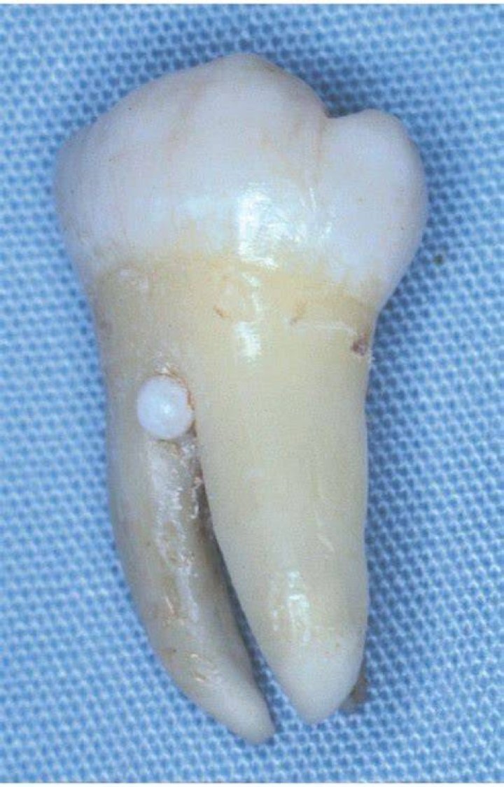 What is enamel pearl in dentistry?