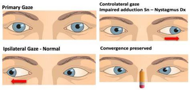 What is gaze misalignment?