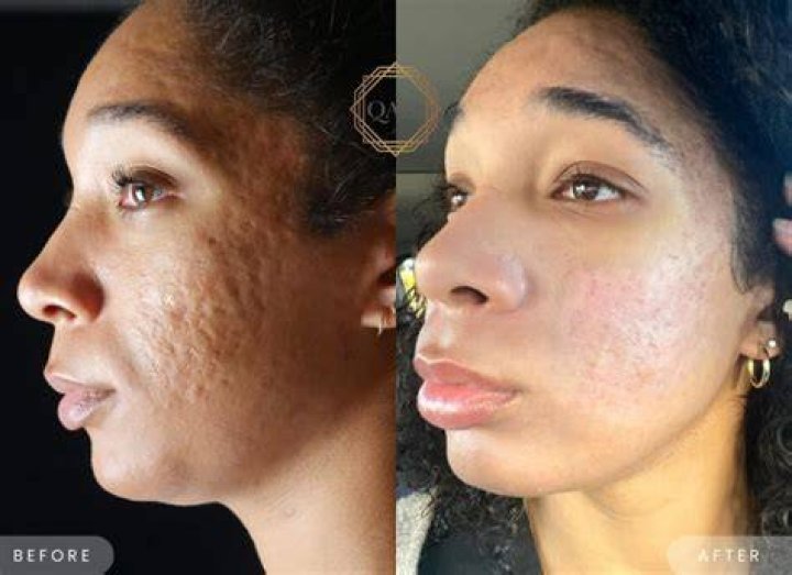 What is good for acne on black skin?