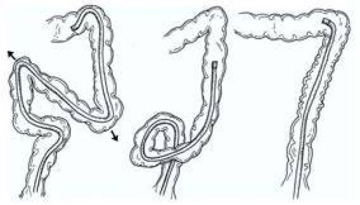 What is looping in colonoscopy?
