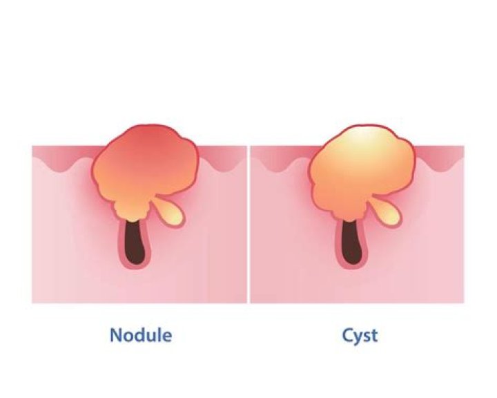 What is the difference between a nodule and a lump?