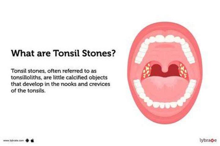 What is the main cause of tonsil stones?