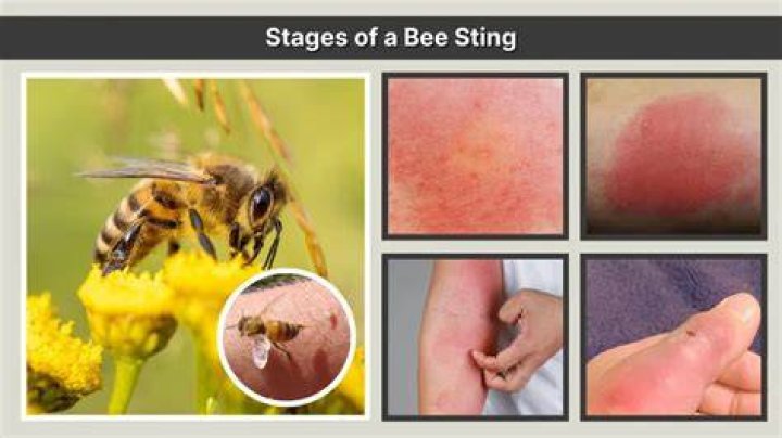 What time of year do bees sting?