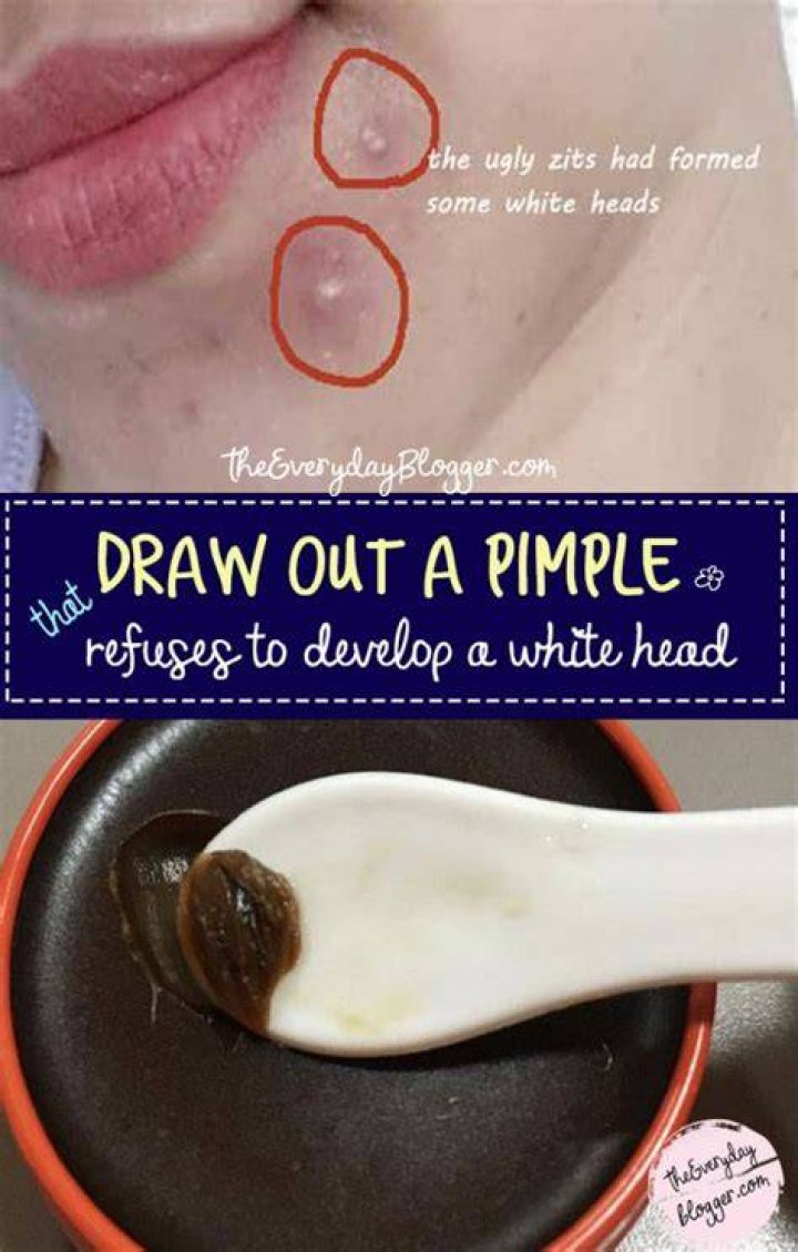 What will draw a pimple to a head?