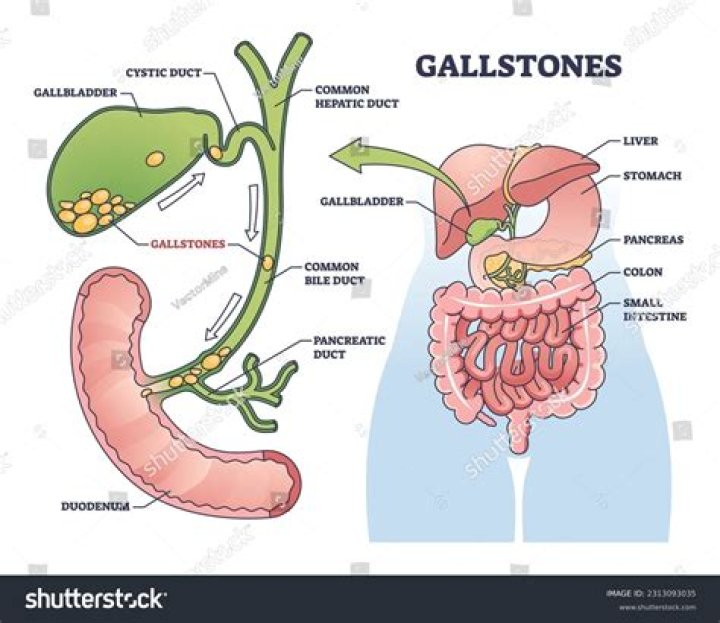 What will happen if gallstone is not removed?