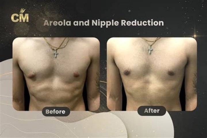 When can I stop covering my nipples after top surgery?