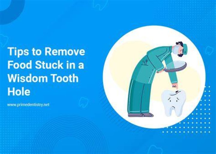 When can I stop worrying about food getting stuck in wisdom teeth holes?