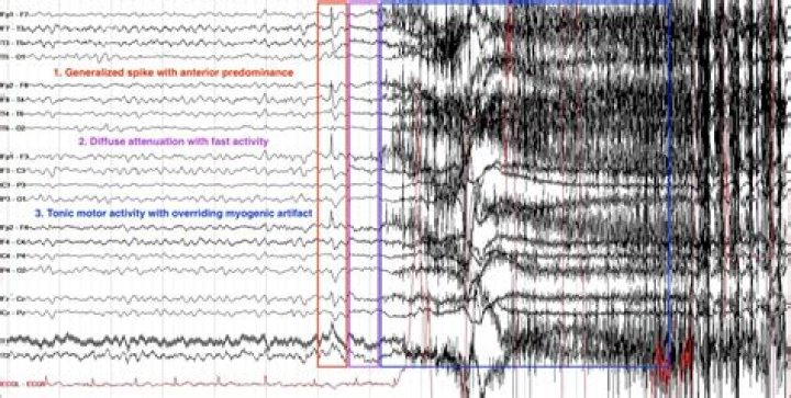 When do you need an EEG after a seizure?