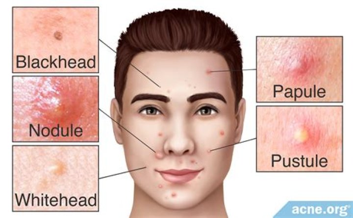 When is a blackhead ready to pop?
