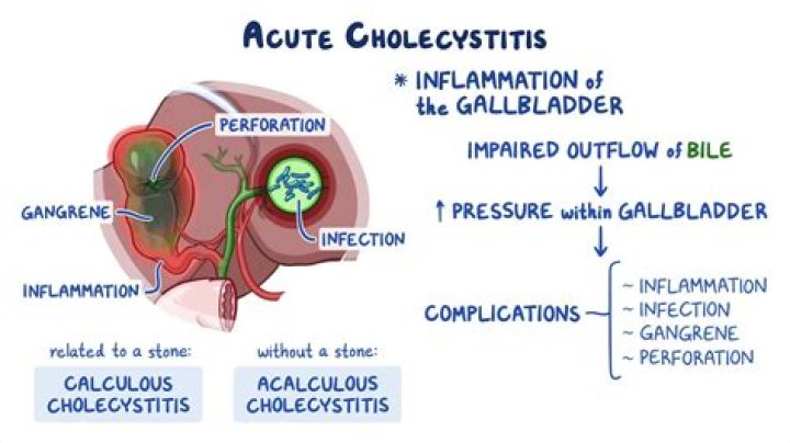 When is surgery needed for cholecystitis?