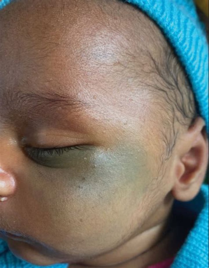 Why are babies born with Mongolian spots?