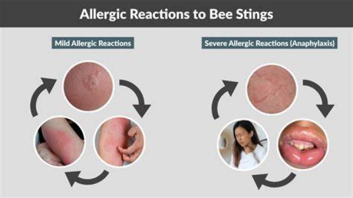 Why did my bee sting swell a day later?