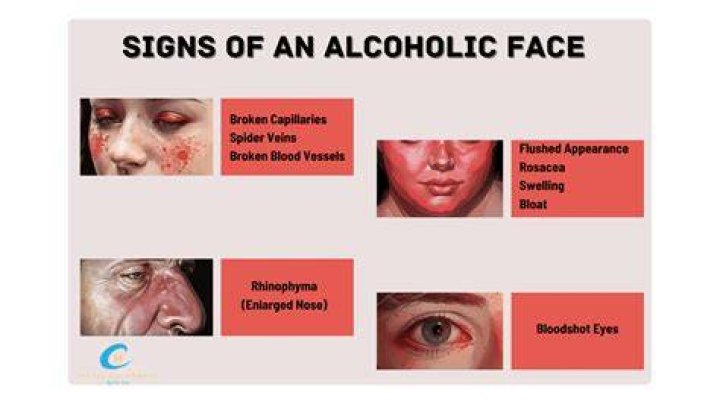 Why do alcoholics have puffy eyes?