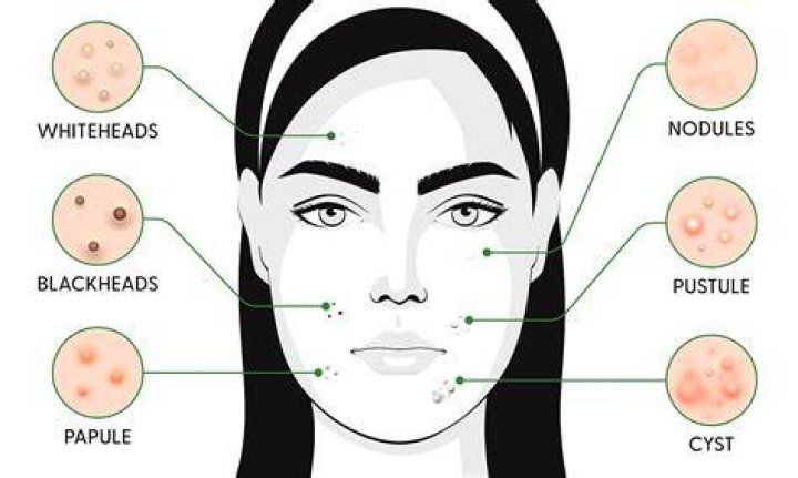 Why do I get pimples after microneedling?