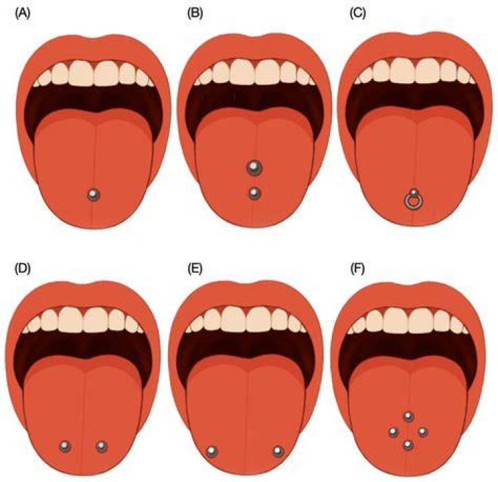 Why do I have a ring around my tongue piercing?