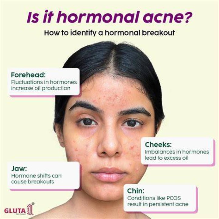 Why do I have hormonal acne?