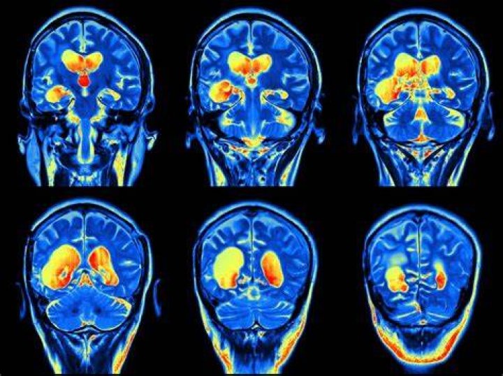 Why do I need an MRI with dye?