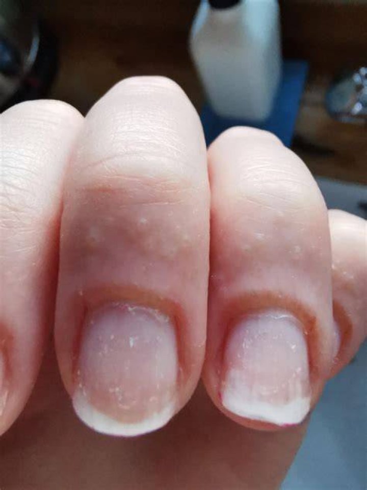Why do my fingers itch after acrylic nails?