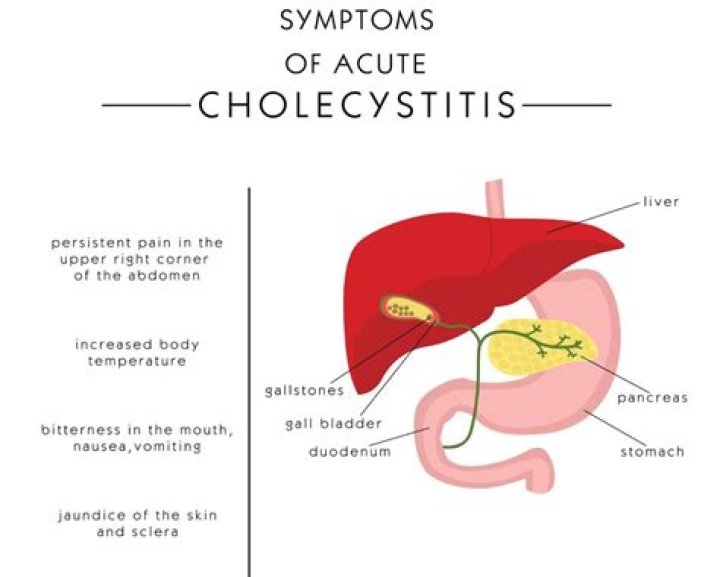 Why is acute cholecystitis an emergency?