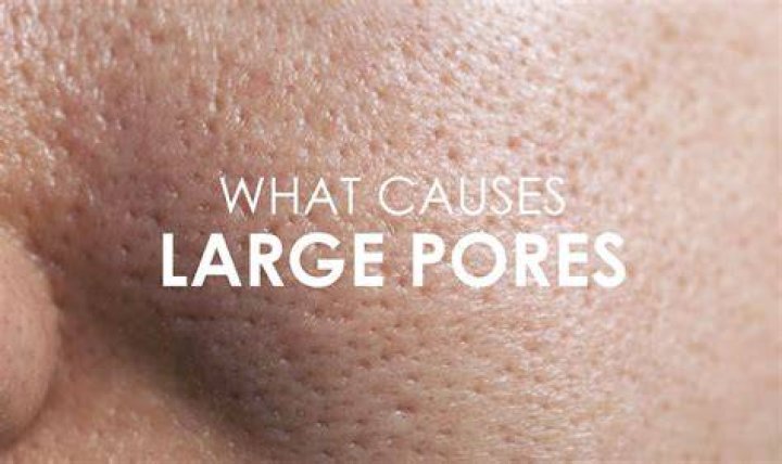 Why is my pores getting bigger?