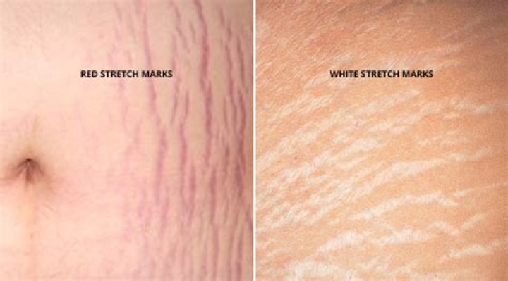 Why would a skinny person have stretch marks?