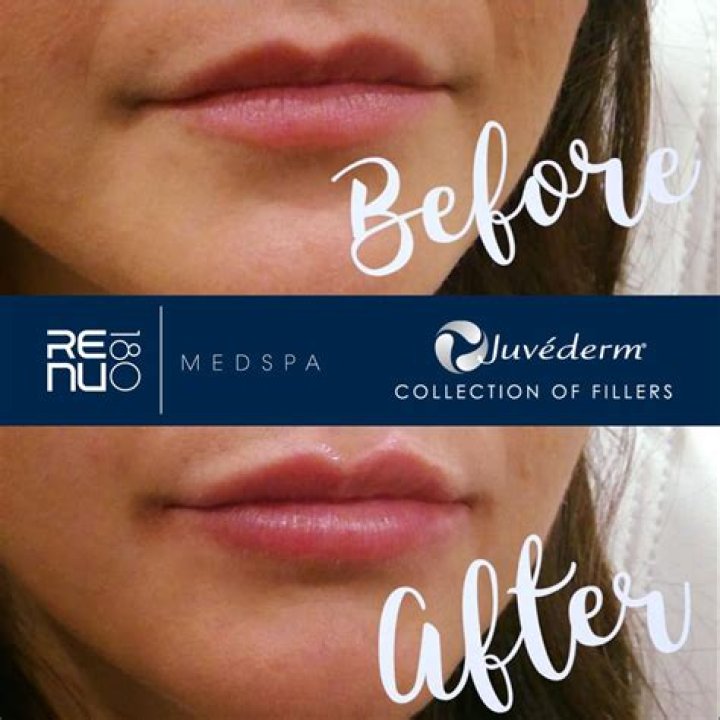 Will juvederm bumps go away?