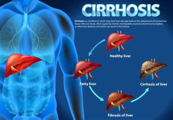 Will they find a cure for cirrhosis?